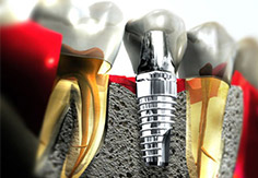 Imagem Implantes Dentários